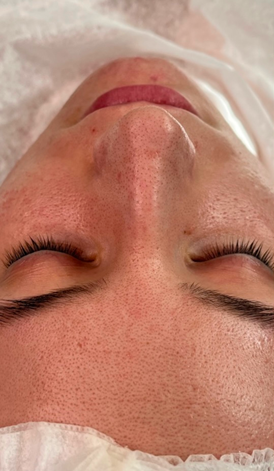 Before extraction facial showing congestion and textured skin