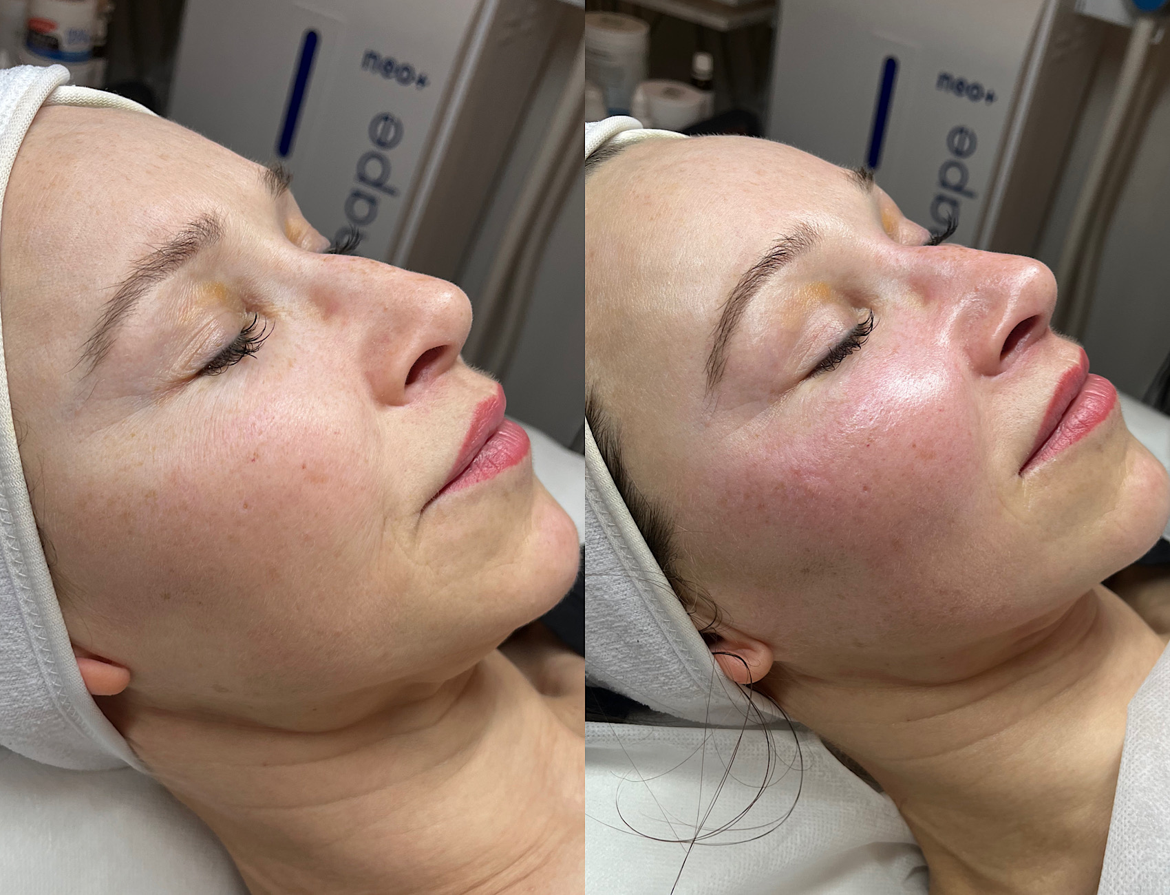 Spring bloom facial before and after comparison showing restored hydration and glow