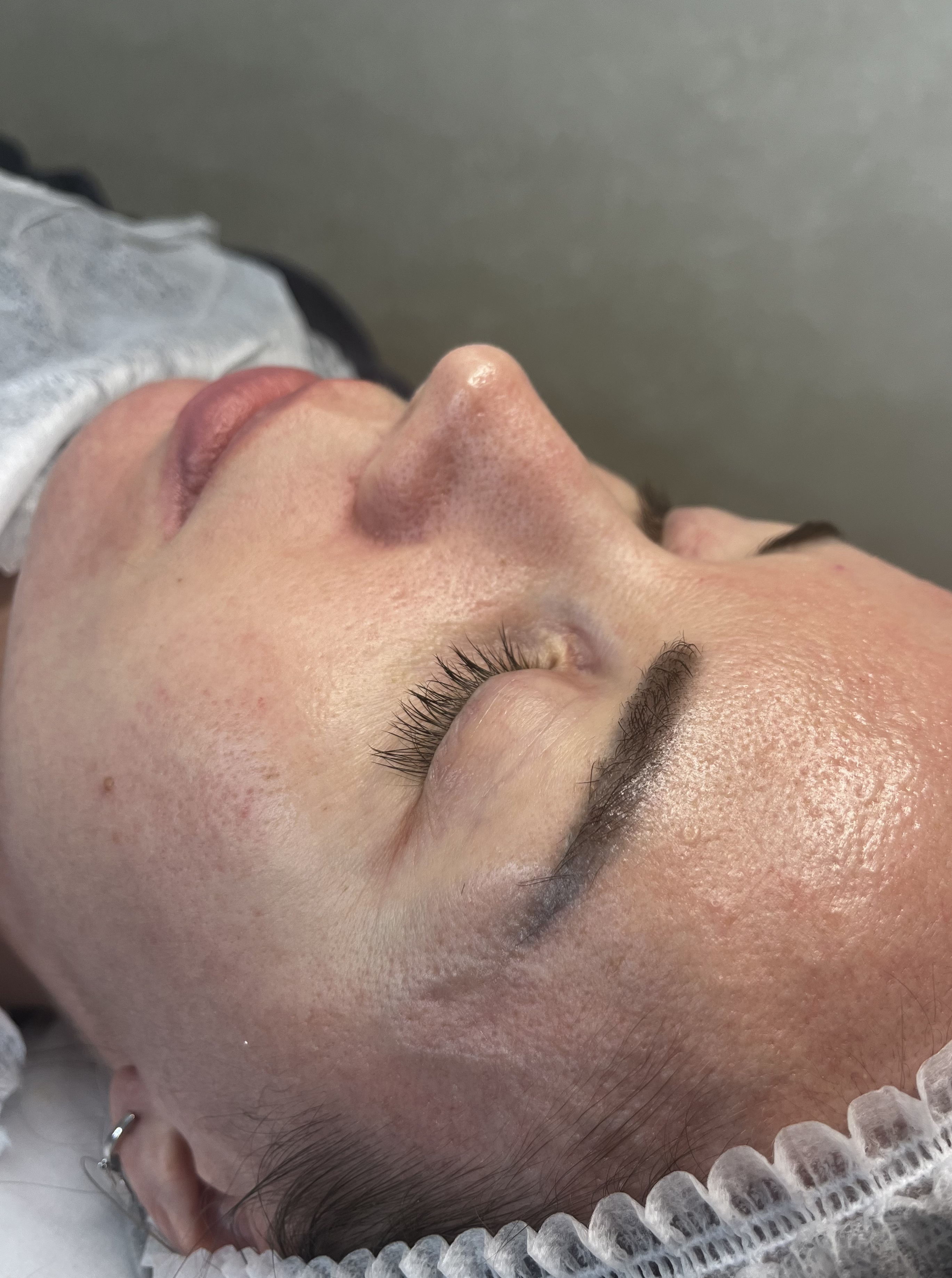 Before personalized facial showing uneven skin texture