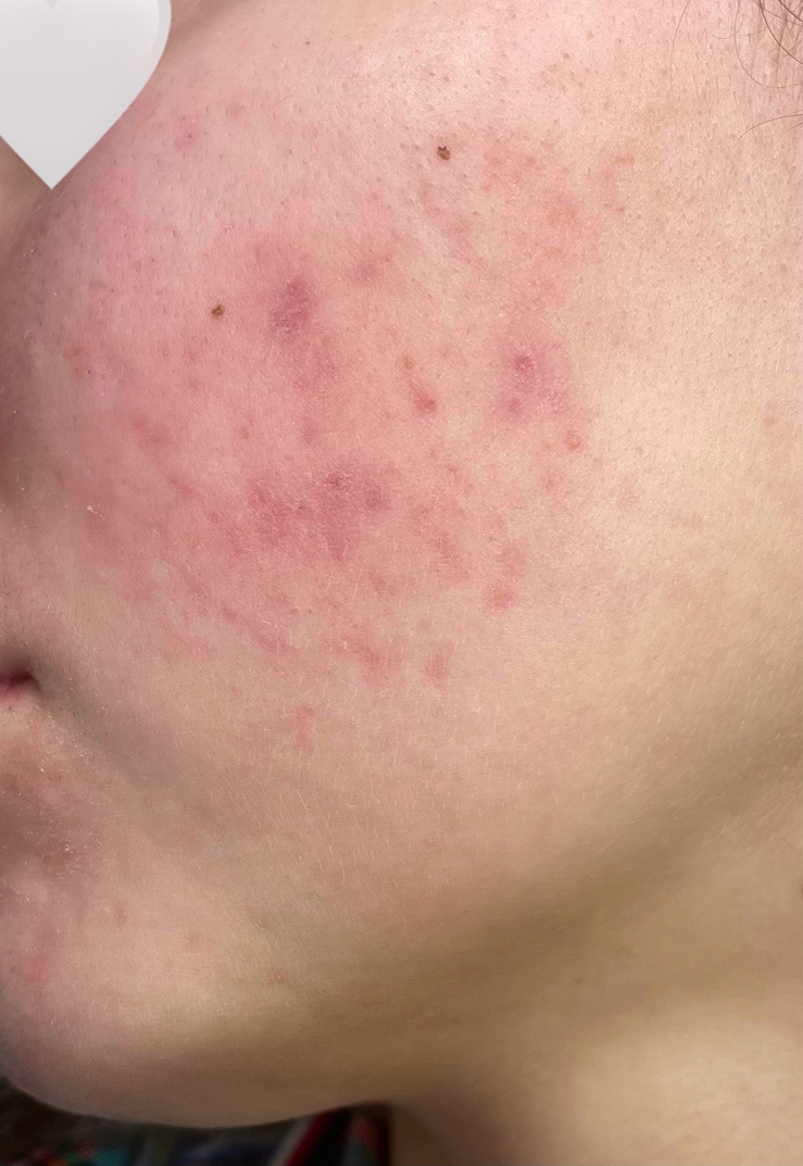 After 3 microneedling sessions showing faded acne marks and even skin tone