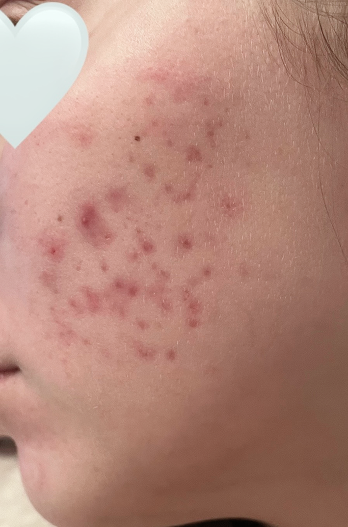 Before microneedling showing post-acne marks and uneven skin tone